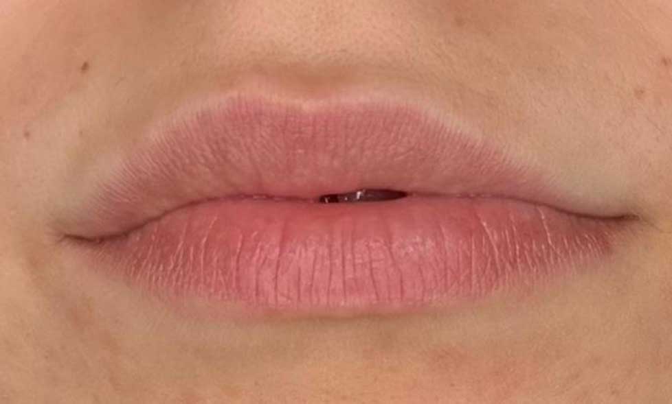 Filler labbra